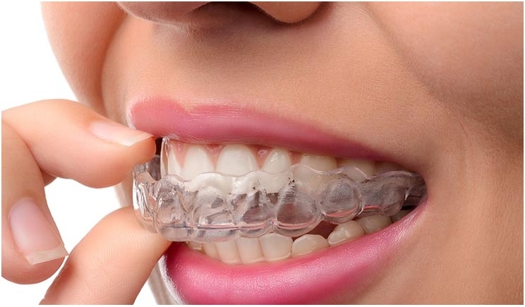 Invisalign aligners